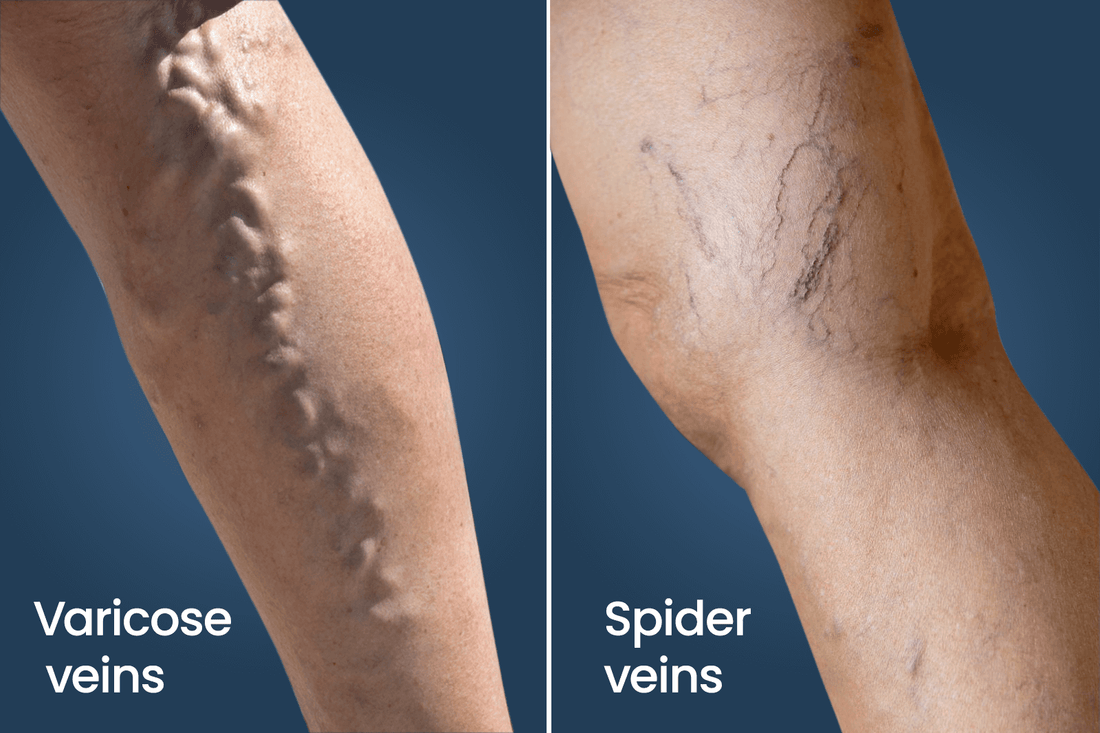 Spider Veins vs Varicose Veins: What’s the Difference?